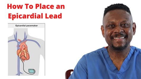 what is an epicardial lead